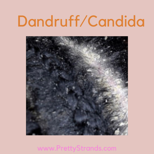 Candida/Dandruff